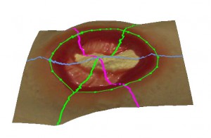 3d-wound-surveillance