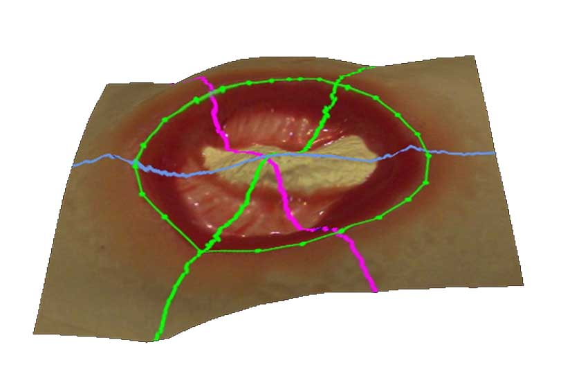 wound 3d surveillance assessment silhouette aranz medical documentation